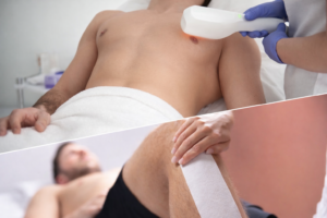 光脱毛とワックス脱毛を組み合わせたミックス脱毛の施術イメージ