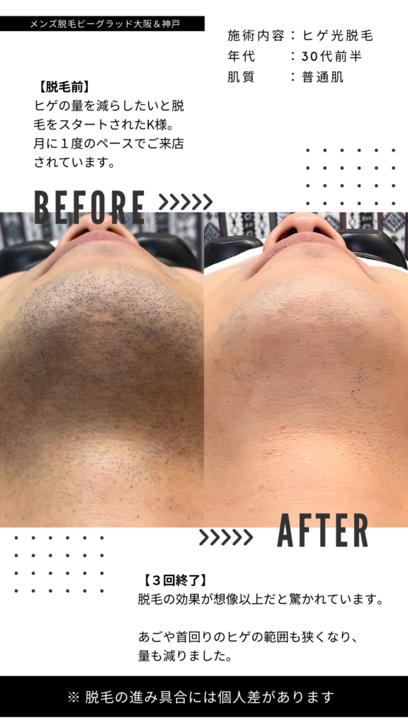 ヒゲ光脱毛｜30代前半・普通肌の施術例