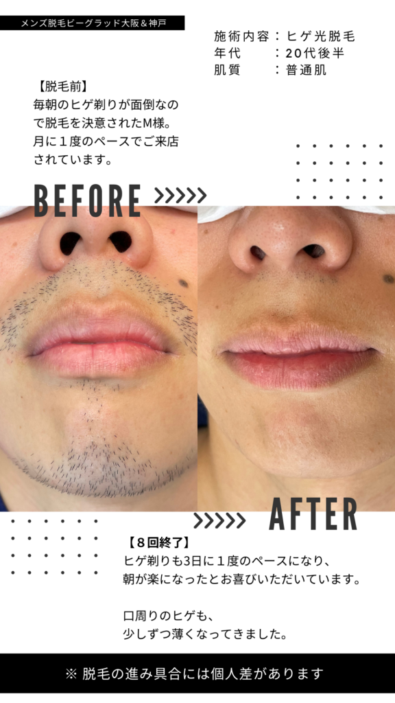 ヒゲ光脱毛｜20代後半・普通肌の施術例