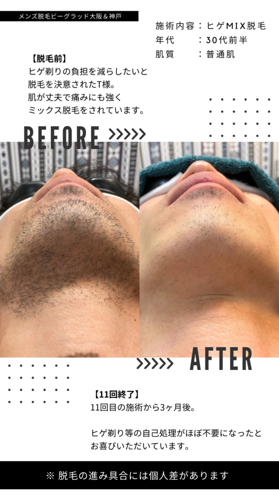 ヒゲミックス脱毛｜30代前半・普通肌の施術例
