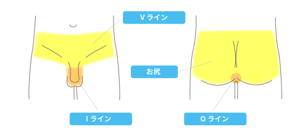 VIO脱毛の部位分け図